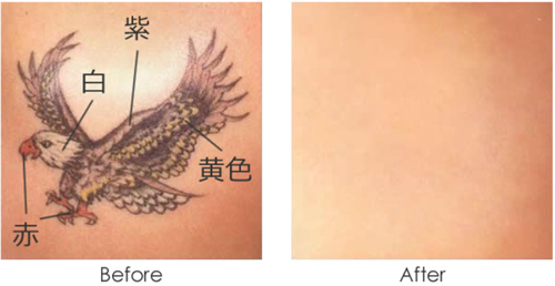 最新pico Yagレーザーによる刺青除去 美容外科 美容皮膚科 形成外科 共立美容外科仙台院