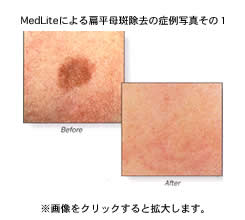 MedLite（メドライト）による扁平母斑除去の症例写真その1 Before After