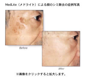 MedLite（メドライト）による顔のシミ除去の症例写真 Before After