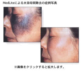 MedLite（メドライト）による太田母斑除去の症例写真 Before After