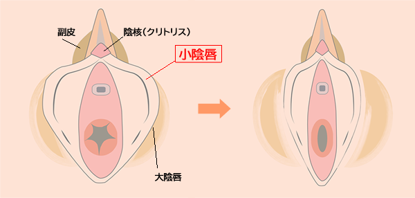 小陰唇