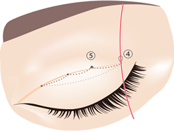 4.両端からの糸を結びます。そして、端の糸に別の糸を通して（④）、引き上げることで⑤の結び目を皮膚の中へ入れることができます。
									  