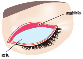 瞼板法の手術手順