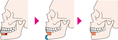下顎歯槽骨骨切り術＋オトガイ形成