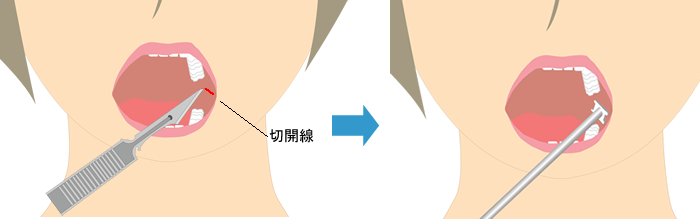 広頚筋ボトックス