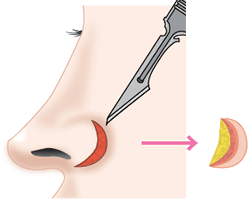 小鼻の基部を皮膚、軟骨とも楔形に1cm程度切除する。
								  